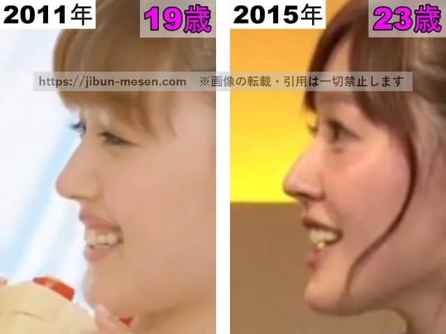 久住小春の鼻の整形検証2011年～2015年（横顔）