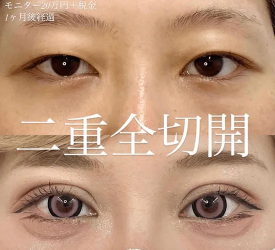 二重切開法による目の整形法（ルラ美容クリニックHPより引用）
