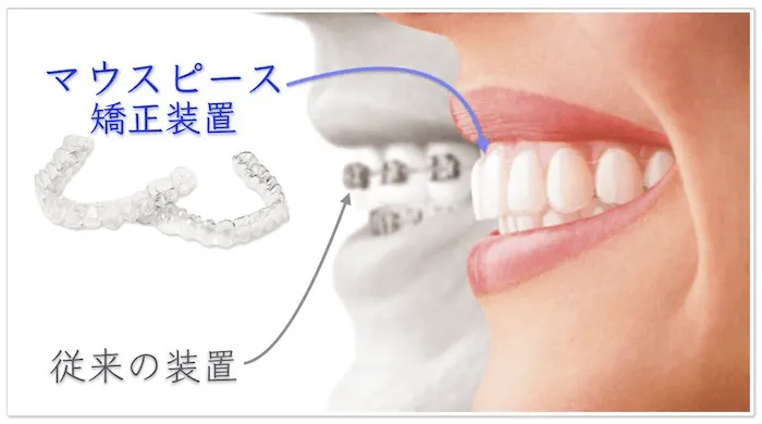 マウスピース矯正装置の見た目(渋谷セントラル矯正歯科HPより引用)