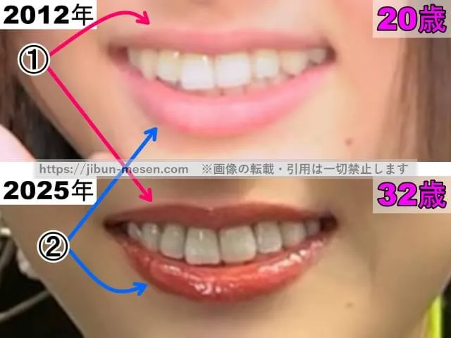 松村沙友理の唇の整形検証2012年～2025年（拡大）