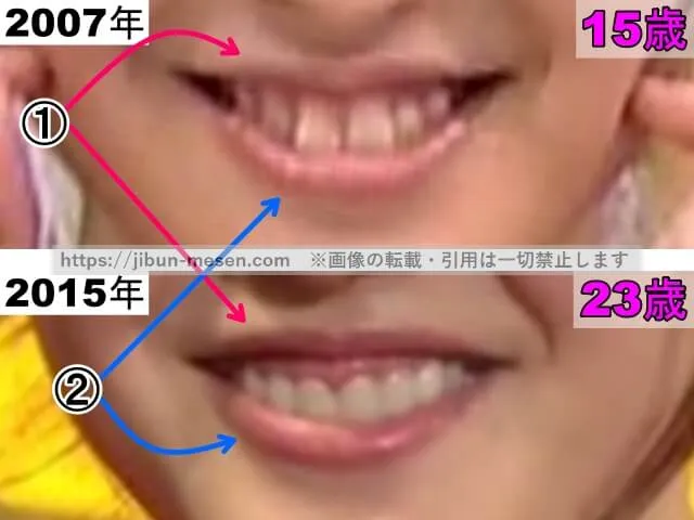 久住小春の唇の整形検証2007年~2015年(拡大)