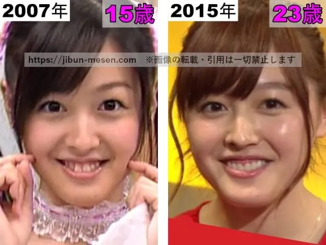 久住小春の唇の整形検証2007年~2015年
