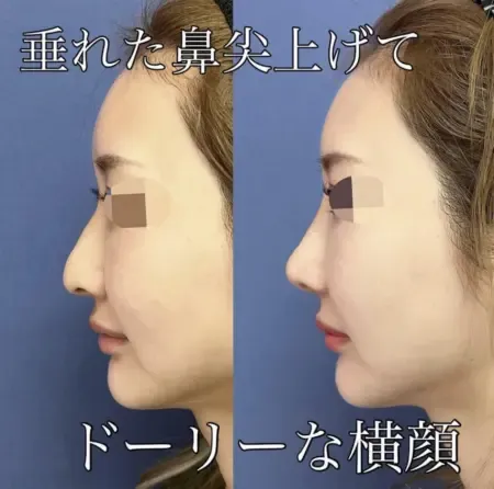 鼻尖挙上術による鼻の整形例（グローバルビューティークリニックHPより引用）