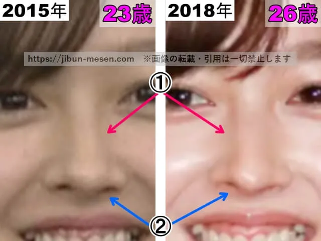 久住小春の鼻の整形検証2015年～2018年（拡大）