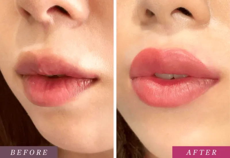 オーバーリップのビフォーアフター(メディカルブローHPより引用)