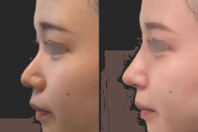 小鼻挙上術による鼻の整形例(東京美専クリニックHPより引用)