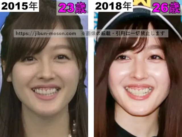 久住小春の鼻の整形検証2015年～2018年