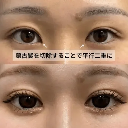目頭切開による目の整形例（グローバルビューティークリニックHPより引用）