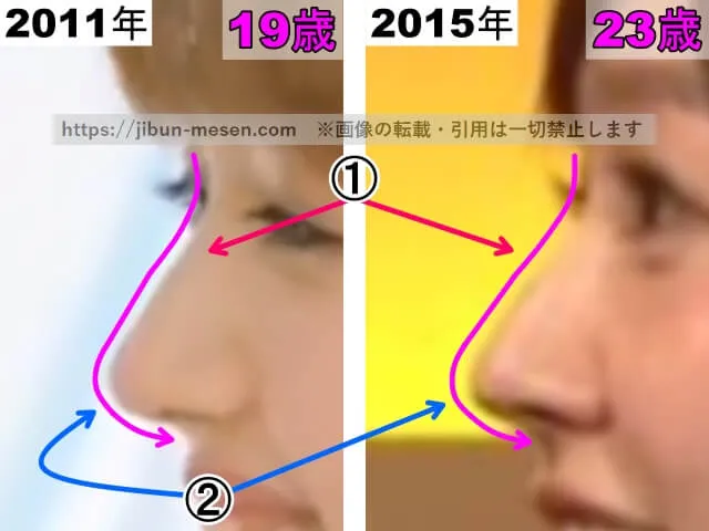久住小春の鼻の整形検証2011年～2015年（横顔・拡大）
