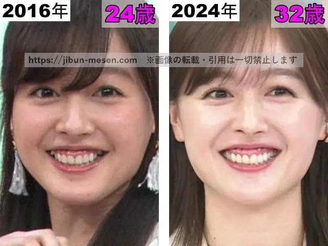 久住小春の唇の整形検証2016年~2024年