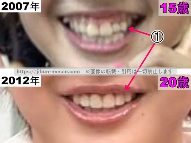 久住小春の唇の整形検証2007年~2012年(拡大)