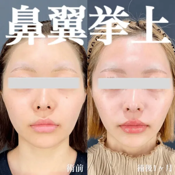小鼻挙上術による鼻の整形例(マエクリニックHPより引用)