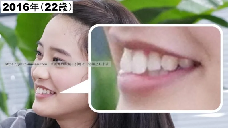 山崎紘菜の前歯