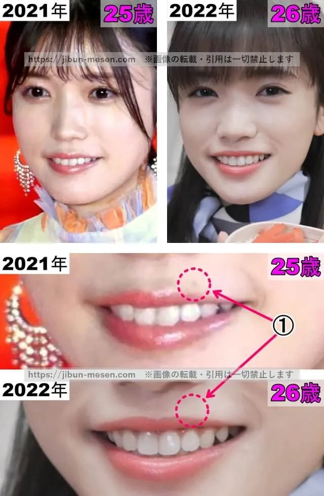 美山加恋のホクロの整形検証2021年〜2022年