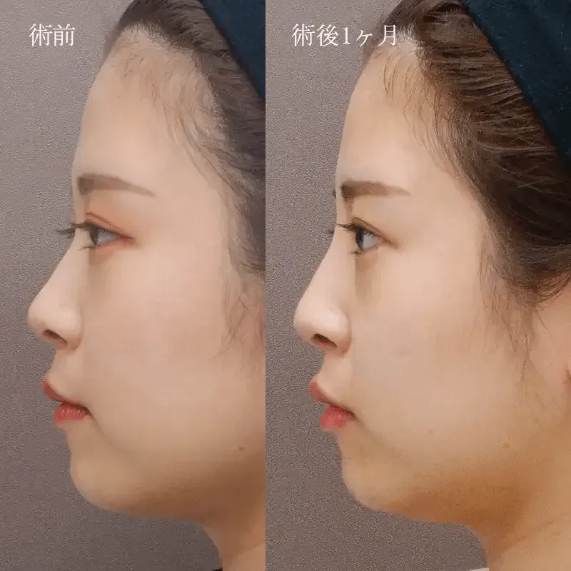 鼻プロテーゼによる鼻の整形例（出典：水の森美容クリニック公式サイト）