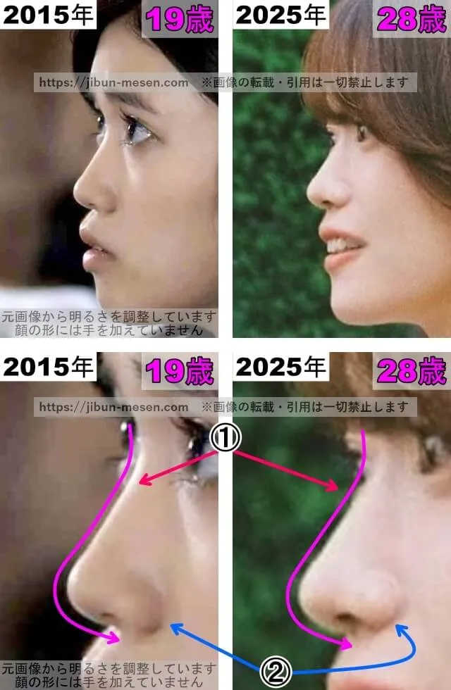 美山加恋の鼻の整形検証2015年〜2025年