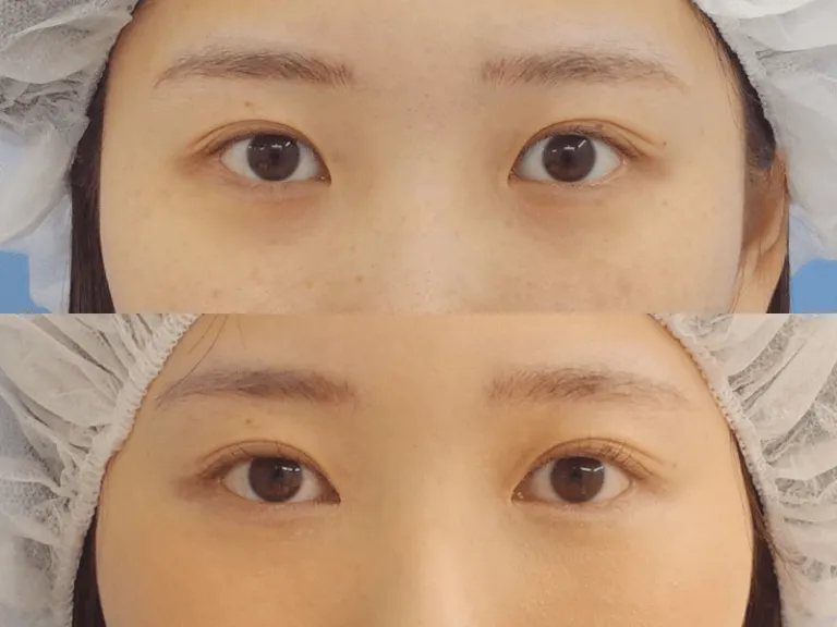 目頭切開による目の整形例(烏丸御池ビューティークリニックHPより引用)