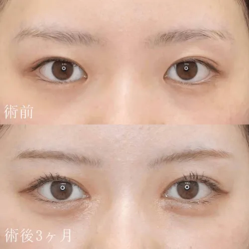目頭切開による目の整形例(水の森美容クリニックHPより引用)