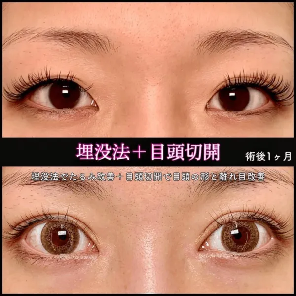 目頭切開による目の整形例（出典：eクリニック公式サイト）