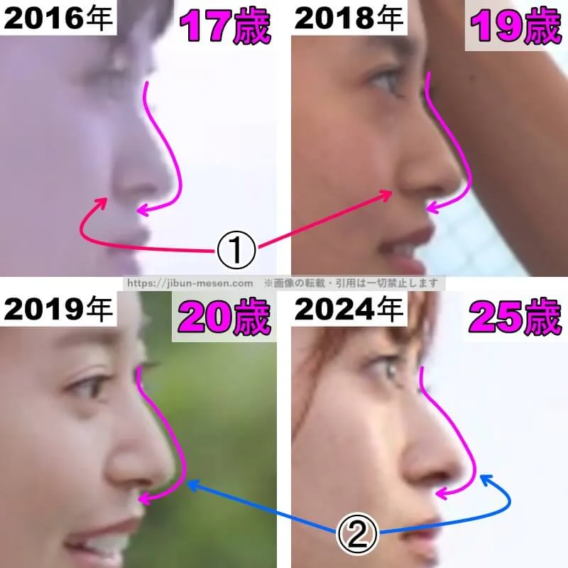 田辺桃子の鼻の整形検証2016年〜2024年（横顔・拡大）