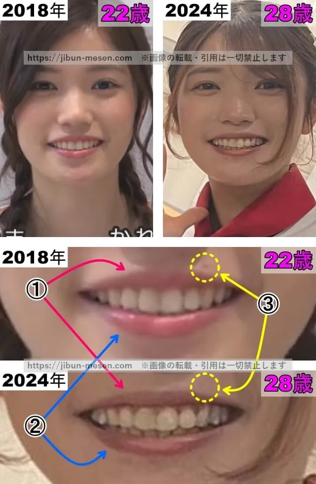 美山加恋の唇の整形検証2018年〜2024年