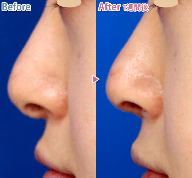 鼻柱挙上術による鼻の整形例（あつぎ美容クリニックHPより引用）