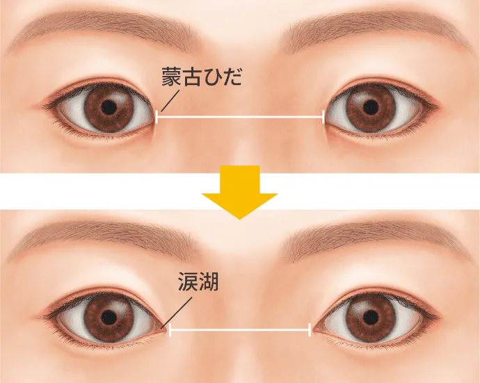 目頭切開の施術イメージ(宮益坂クリニックHPより引用)
