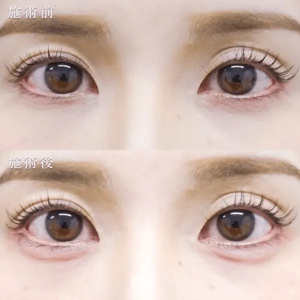 涙袋のヒアルロン酸注射による目の整形例(東京中央美容外科HPより引用)