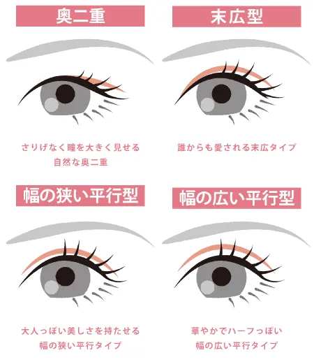二重まぶたの種類（グローバルビューティークリニックHPより引用）