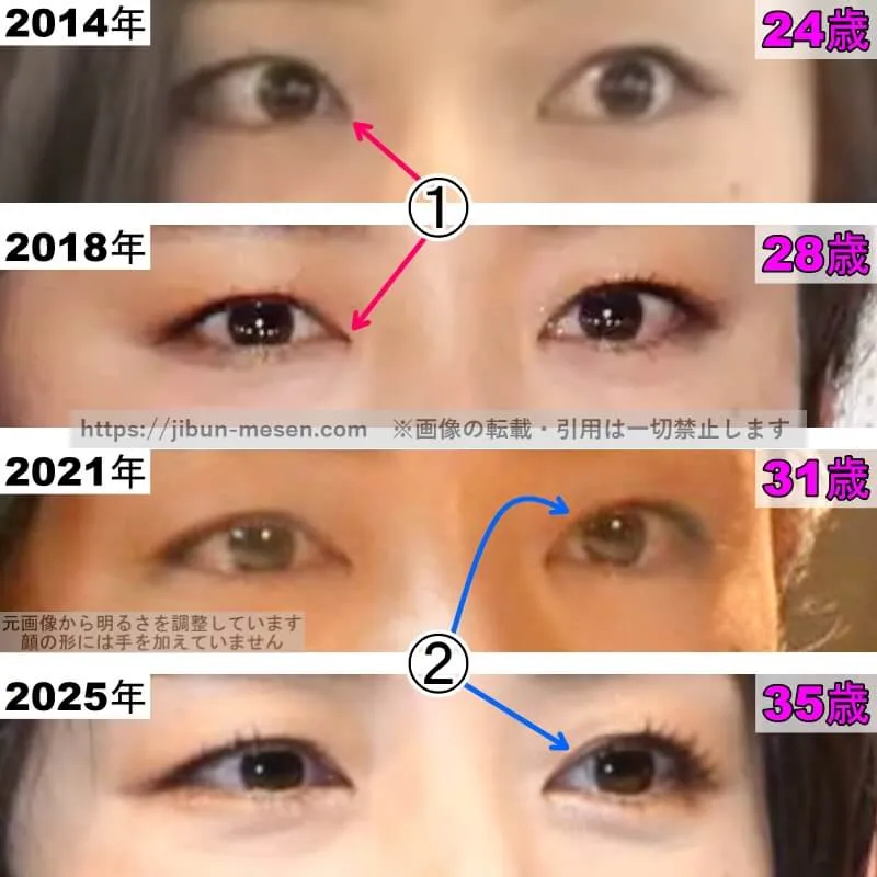 片山萌美の目の整形検証2014年〜2025年（拡大）