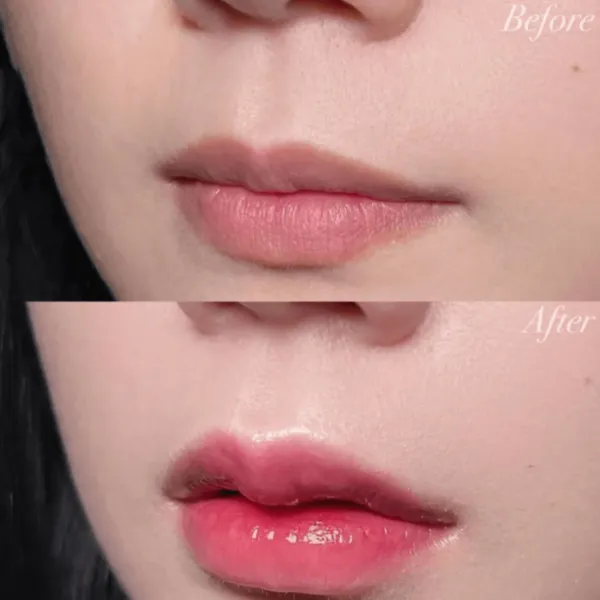ヒアルロン酸注射による唇の整形例（出典：アールビューティークリニック公式サイト）