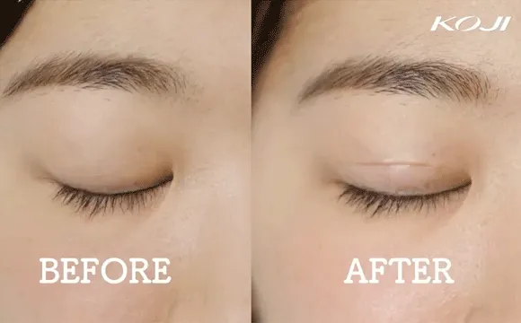 アイテープの使用例（出典：KOJI）