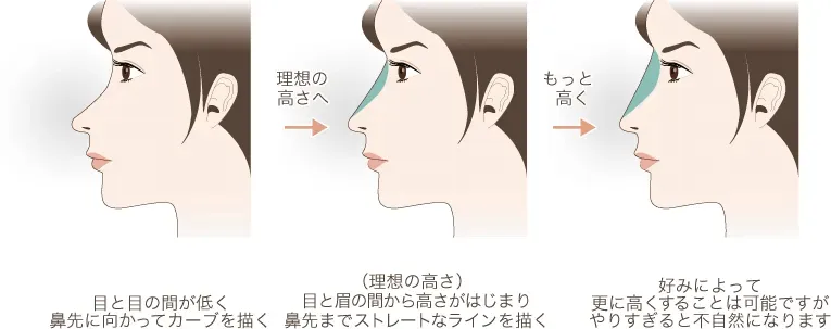 鼻のヒアルロン酸注射の理想(出典:水の森美容クリニック公式サイト)