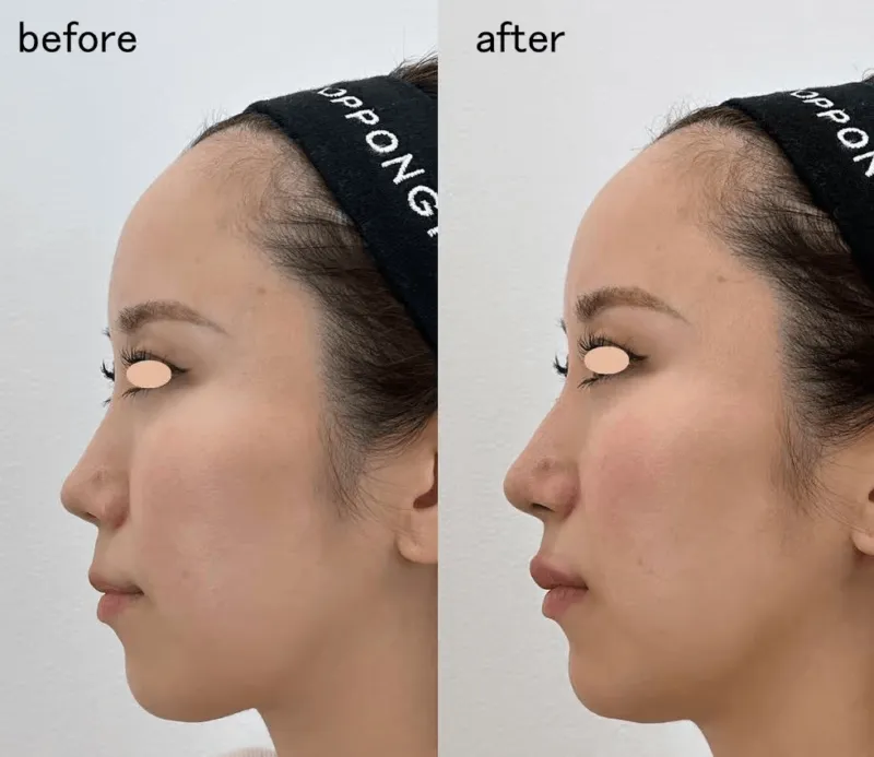 ヒアルロン酸注射による鼻の整形例(出典:ザロッポンギクリニック公式サイト)