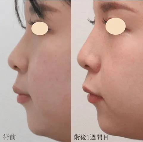 ヒアルロン酸注射による鼻の整形例（出典：メディカルアルファクリニック公式サイト）