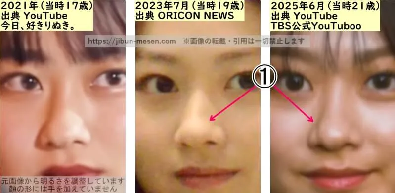 水戸由菜の鼻の整形検証2021年~2025年(拡大)