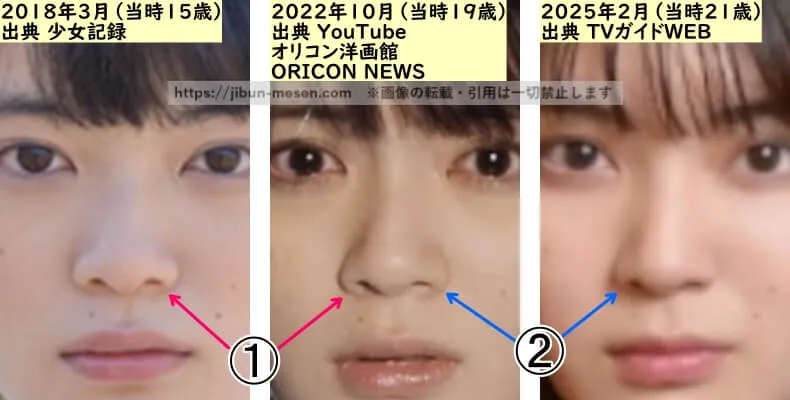 吉田美月喜の鼻の整形検証2018年～2025年（横顔・拡大）