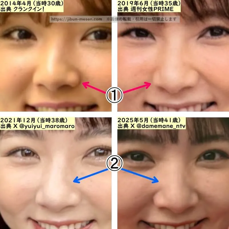 野呂佳代の鼻の整形検証2014年～2025年（拡大）