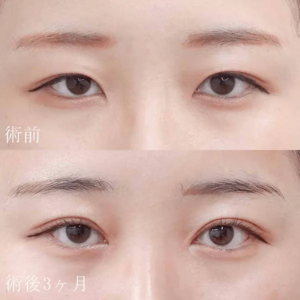 二重埋没法と目頭切開による目の整形例（出典：水の森美容クリニック公式サイト）