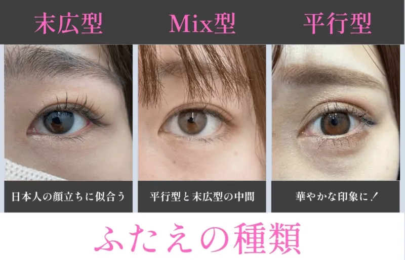 二重まぶたの種類（出典：湘南美容クリニック公式サイト）
