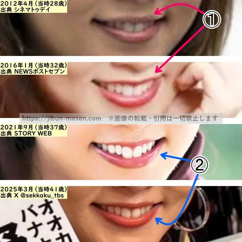 野呂佳代の唇の整形検証2012年～2025年（拡大）
