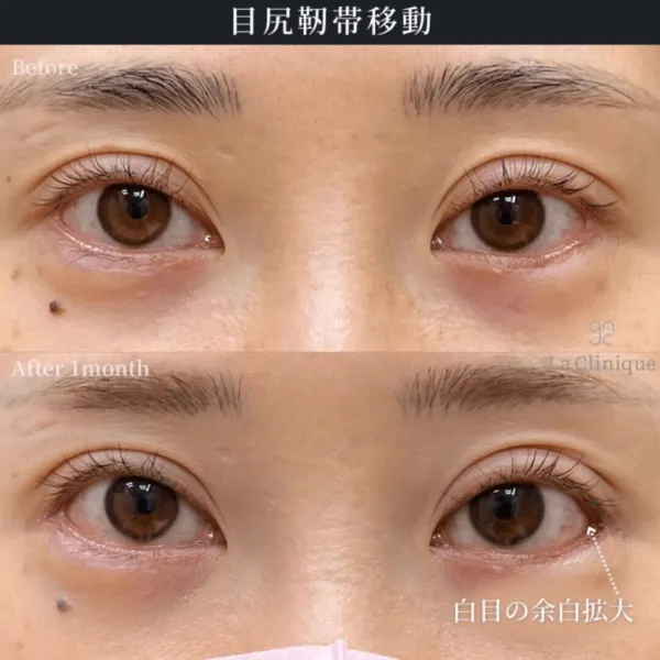 目尻靭帯移動術による目の整形例（出典：ラクリニック公式サイト）