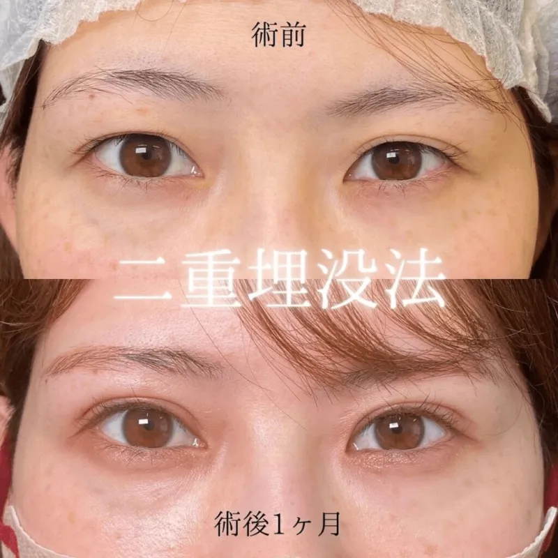 二重埋没法による目の整形例(出典:eクリニック公式サイト)