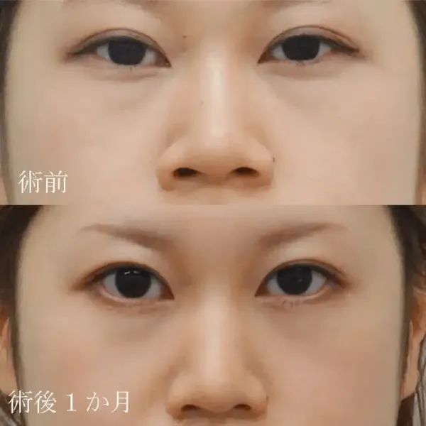 小鼻縮小術による鼻の整形例（出典：水の森美容クリニック公式サイト）
