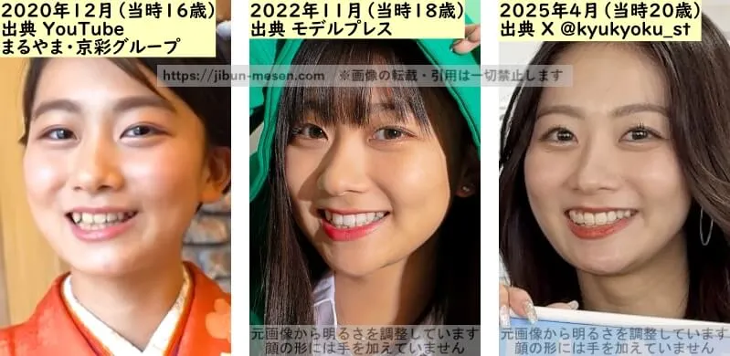 水戸由菜の唇の整形検証2020年~2025年