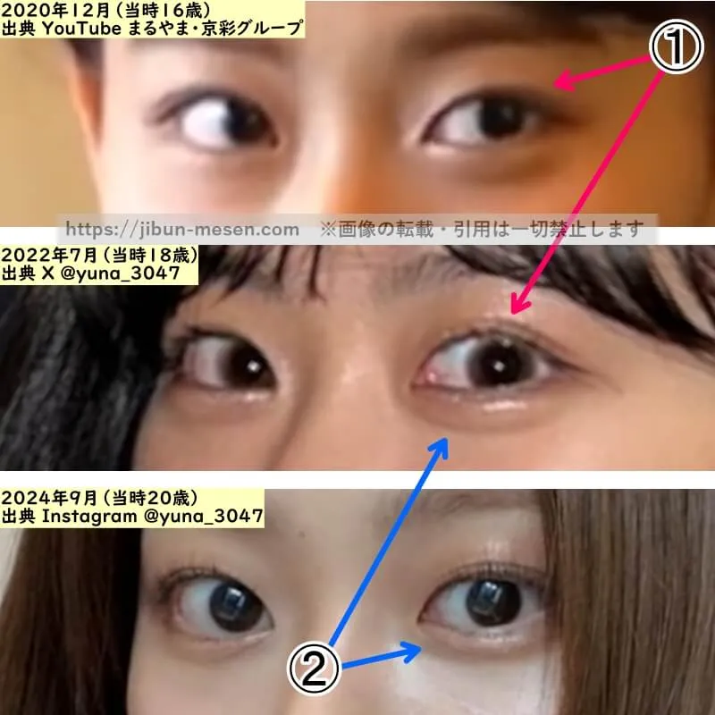水戸由菜の目の整形検証2020年～2024年（拡大）