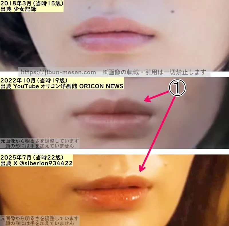 吉田美月喜の唇の整形検証2018年～2025年（拡大）