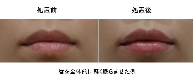 ヒアルロン酸注射による唇の整形例（出典：渋谷高野美容医院公式サイト）