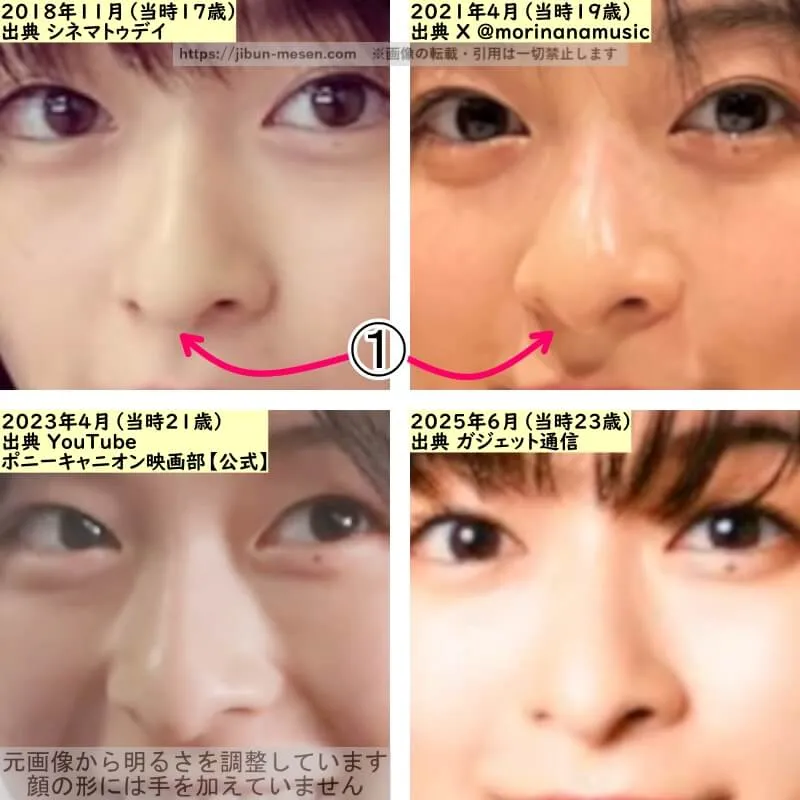 森七菜の鼻の整形検証2018年～2025年（拡大）