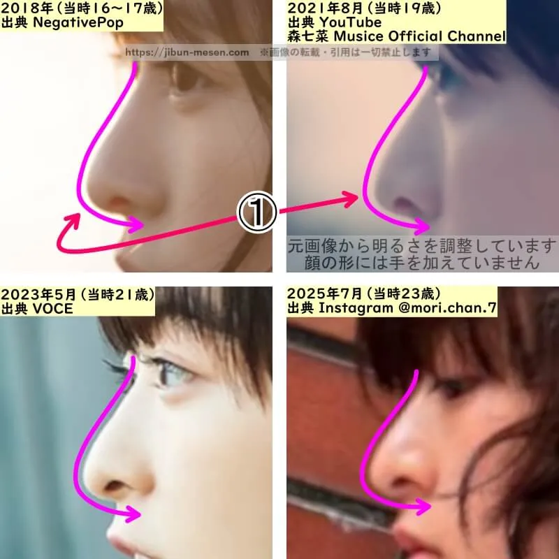 森七菜の鼻の整形検証2018年～2025年（横顔・拡大）